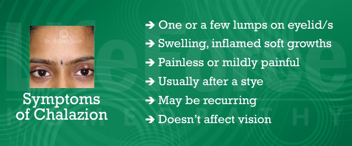 Symptoms of Chalazion